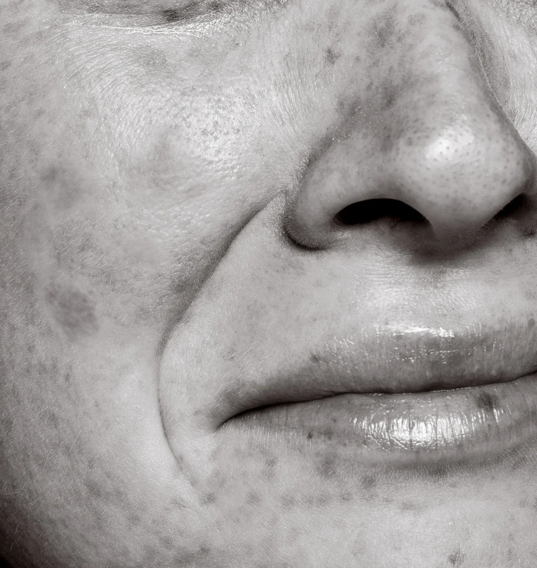 Age Spots Treatment in NYC