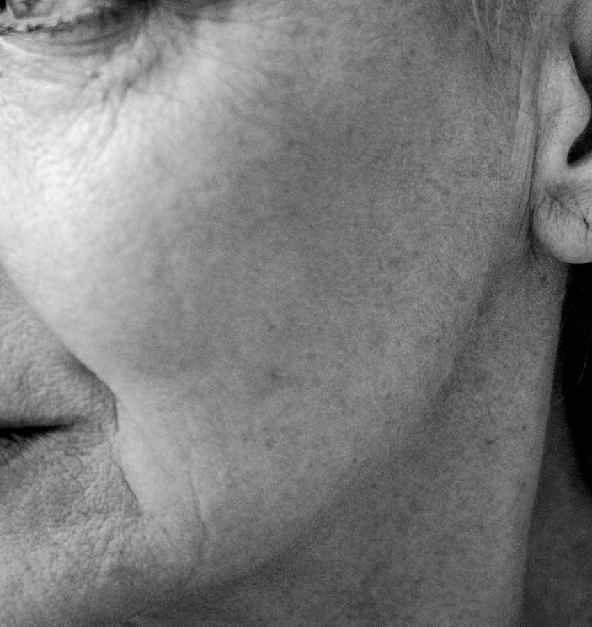 Aging Skin Treatment in NYC