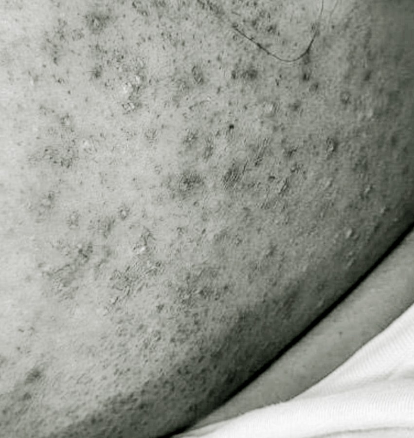 Ingrown Hairs Treatment in NYC