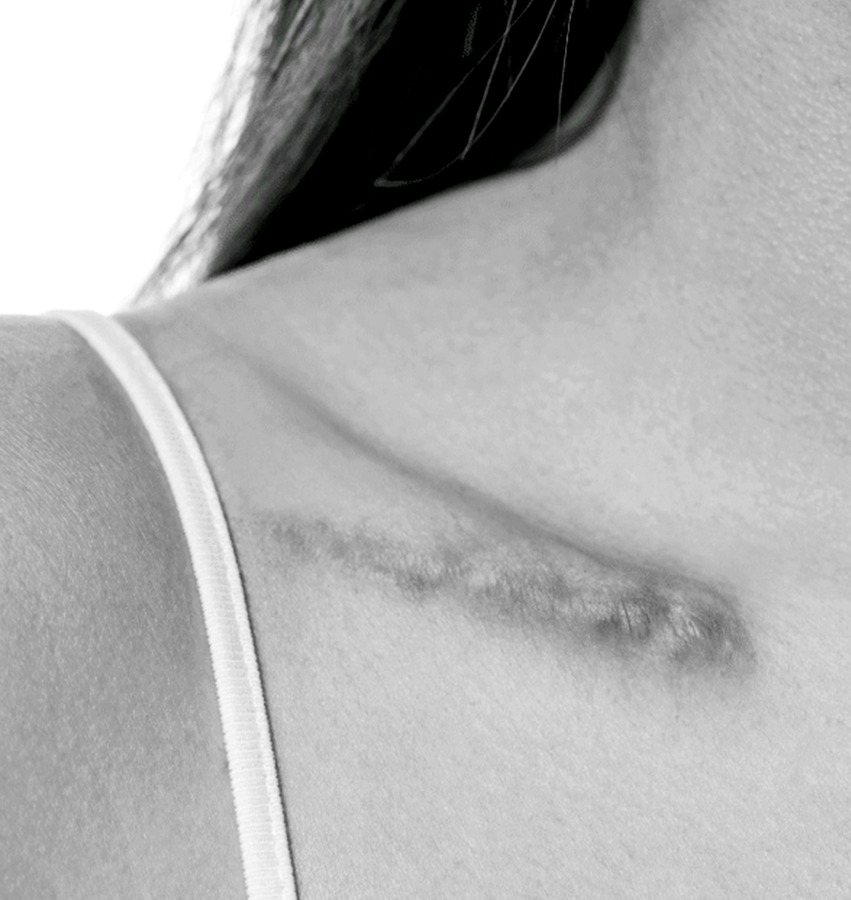 Keloid Scars Treatment in NYC