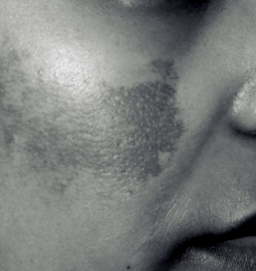 Melasma Skin Condition Treatment in NYC