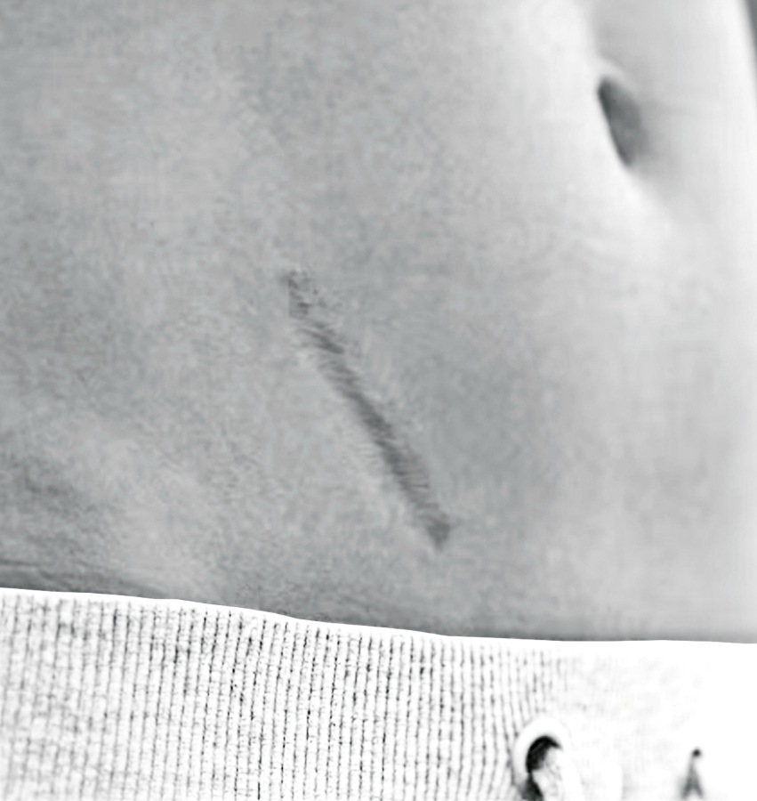 Scars Treatment in NYC