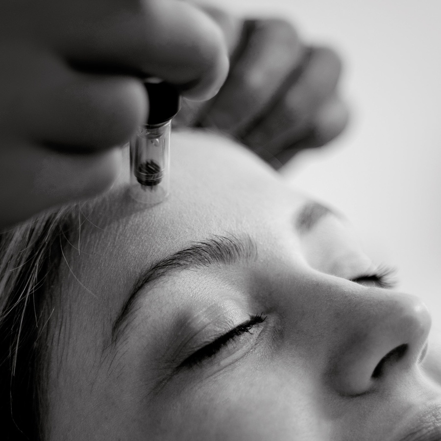 SkinPen Microneedling