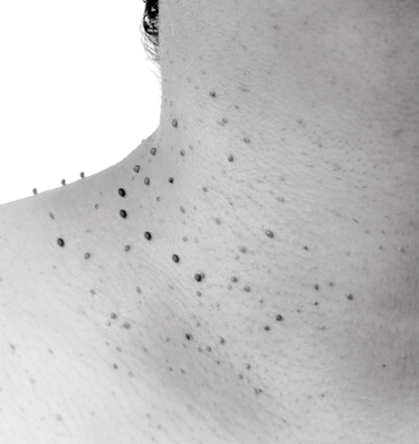 Skin Tag Removal in NYC