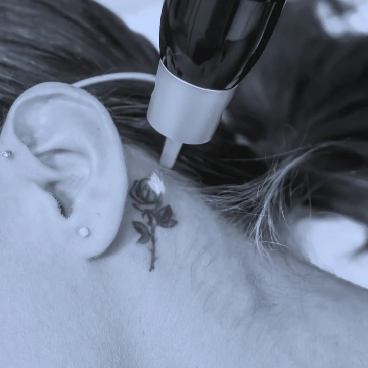 Tattoo Removal